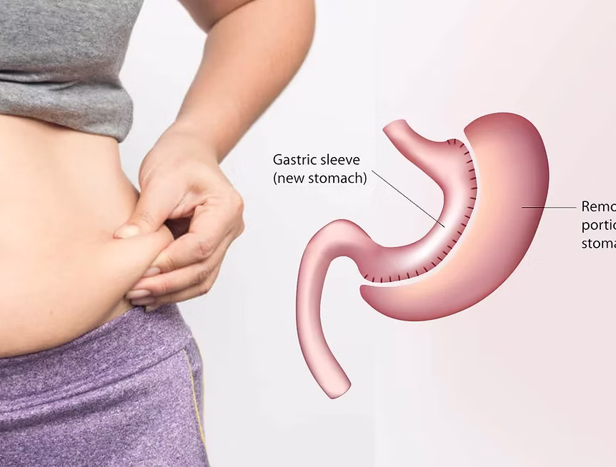 Gastric Sleeve Istanbul – Gastric Sleeve Turkey – Gastric Sleeve Hospital Turkey – Gastric Sleeve Cost Turkey – Best Gastric Sleeve Turkey