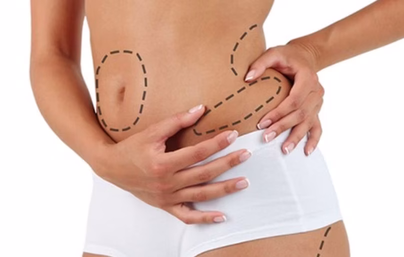 Liposuction Turkey surgery preparation in a modern clinic offering 360 liposuction Turkey and advanced body contouring