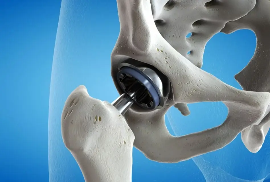 Hip Replacement Istanbul – Hip Replacement in Turkey – Hip Replacement Cost Turkey – Best Hip Replacement Turkey – Hip Replacement Recovery Turkey
