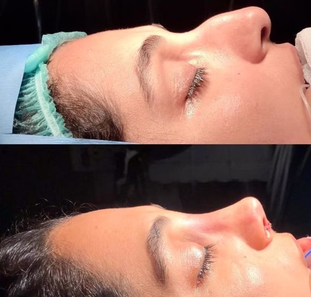 Rhinoplasty Turkey before after Turkey results review showing improved nasal shape and facial harmony
