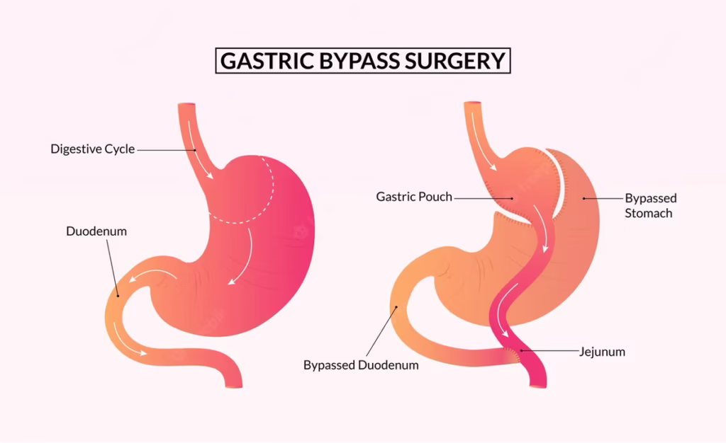 Gastric Bypass Istanbul – Gastric Bypass Turkey – Mini Gastric Bypass Turkey – Gastric Bypass Cost Turkey – Gastric Bypass Clinic Turkey