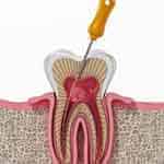 TRATTAMENTO CANALARE